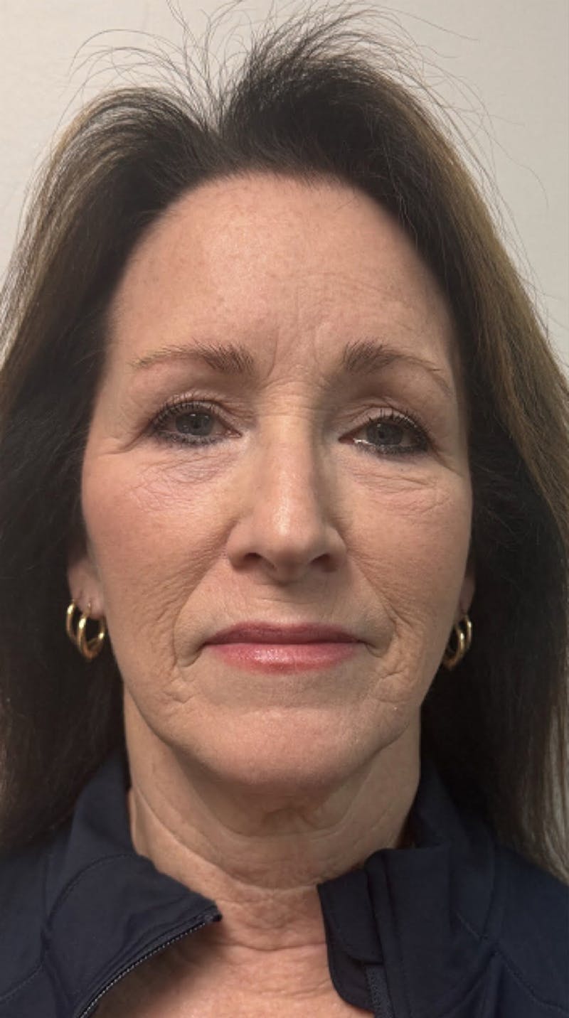 QuickLift Before & After Gallery - Patient 367521 - Image 1