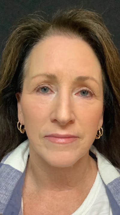 QuickLift Before & After Gallery - Patient 367521 - Image 2