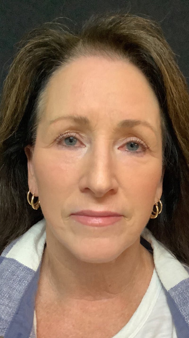 QuickLift Before & After Gallery - Patient 367521 - Image 2