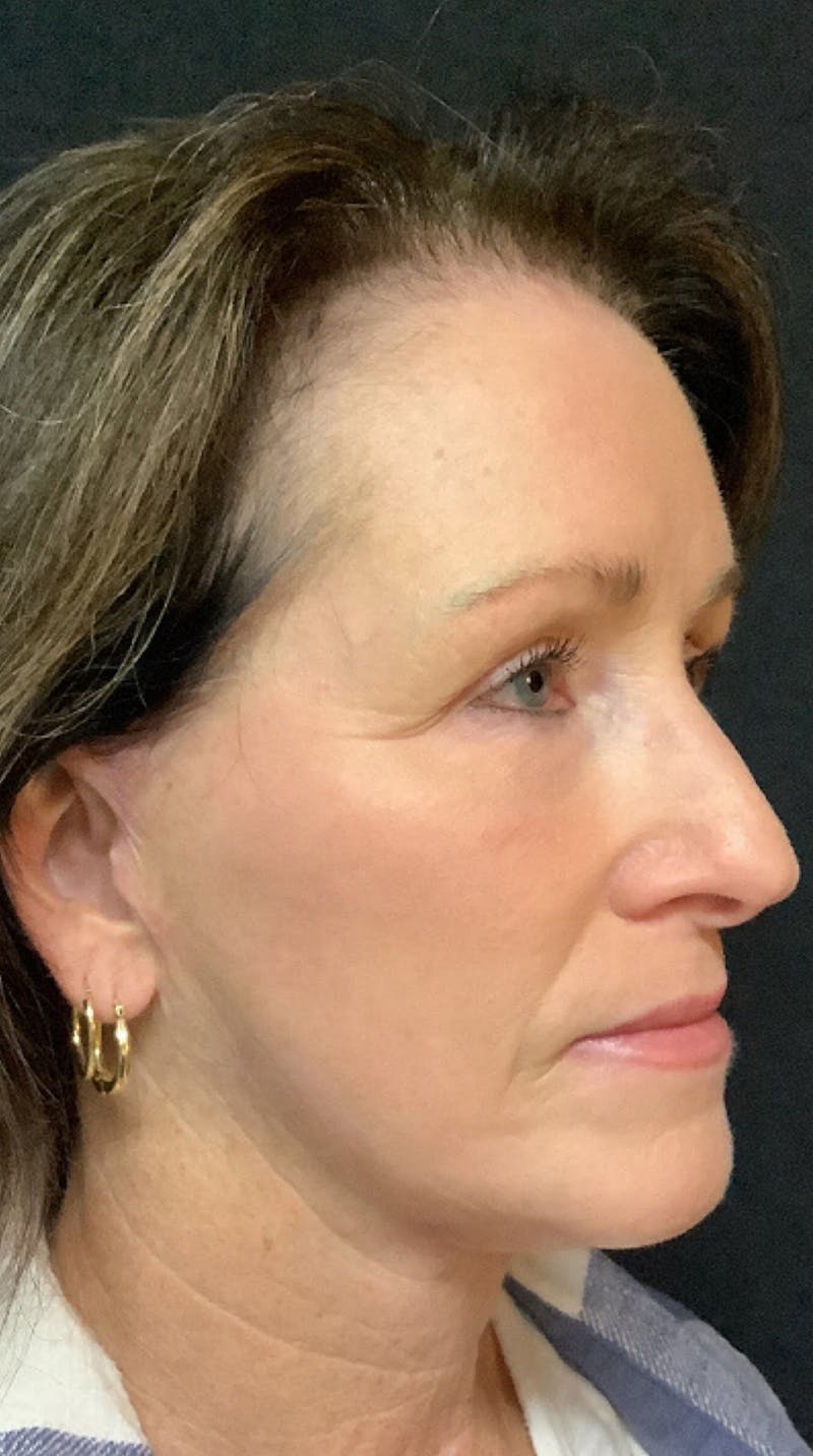 QuickLift Before & After Gallery - Patient 367521 - Image 4