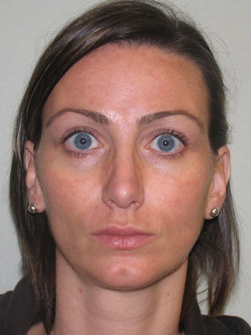 QuickLift Before & After Gallery - Patient 356532 - Image 1