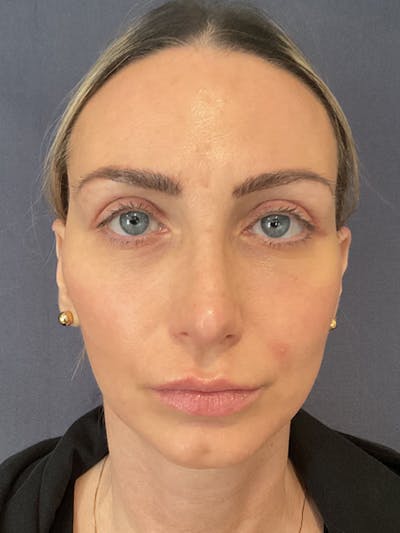 QuickLift Before & After Gallery - Patient 356532 - Image 2