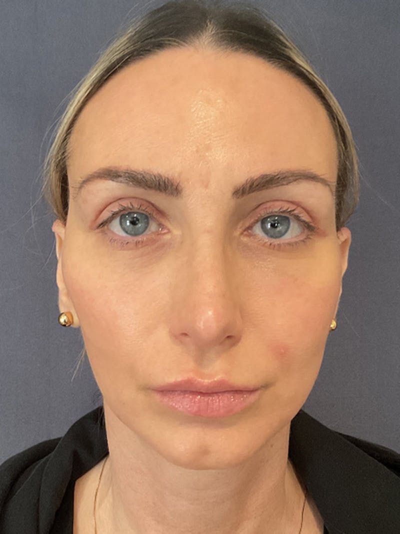 QuickLift Before & After Gallery - Patient 356532 - Image 2