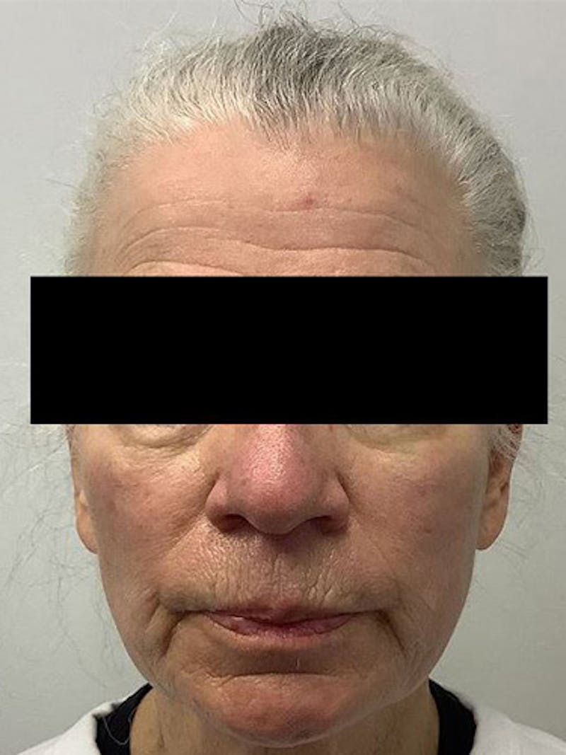 QuickLift Before & After Gallery - Patient 313503 - Image 1