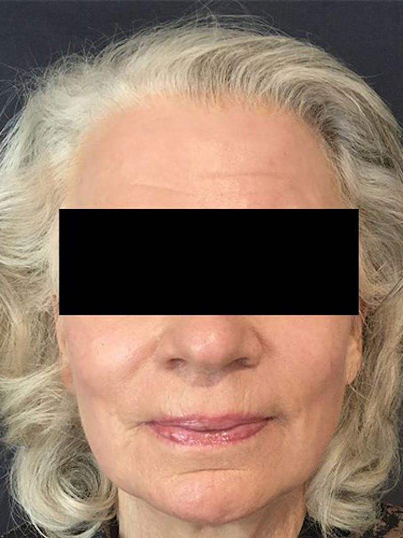 QuickLift Before & After Gallery - Patient 313503 - Image 2