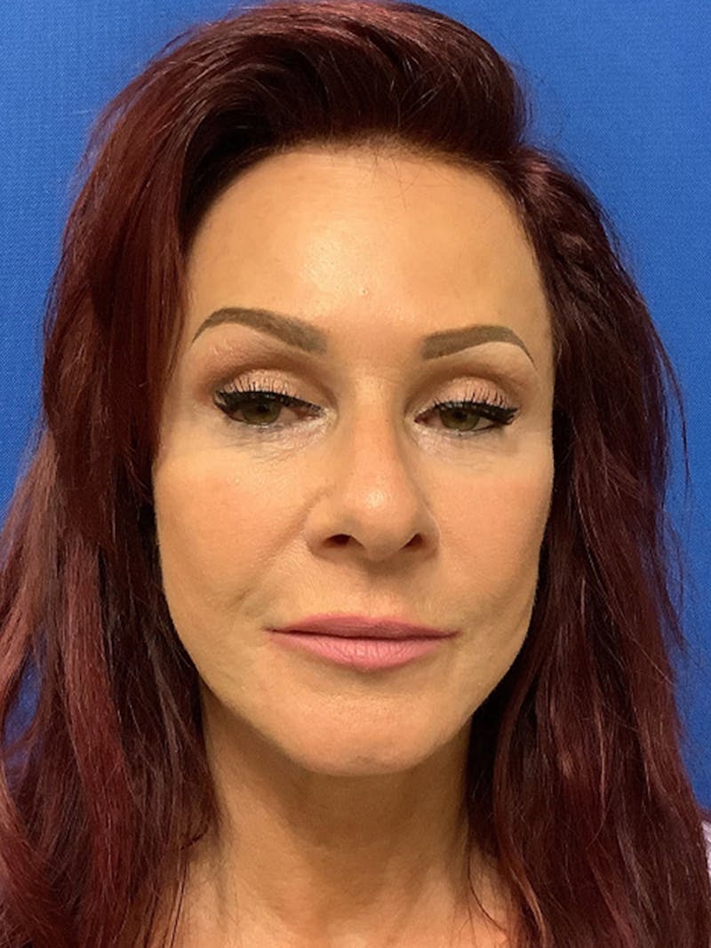 QuickLift Before & After Gallery - Patient 151550 - Image 2