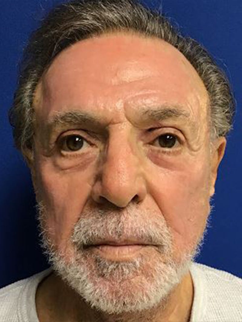 QuickLift Before & After Gallery - Patient 362946 - Image 2