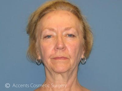 QuickLift Before & After Gallery - Patient 105543 - Image 1