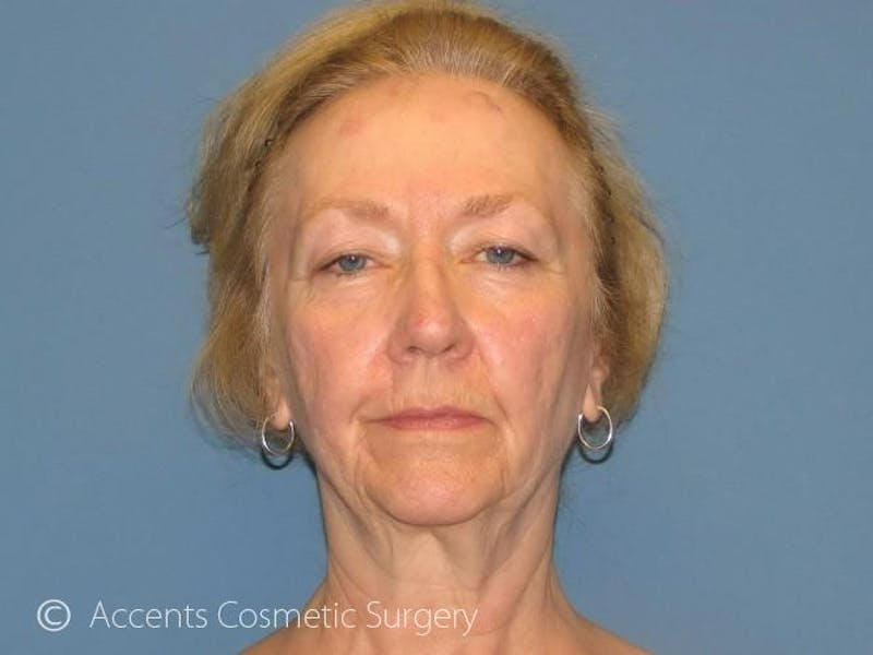 QuickLift Before & After Gallery - Patient 105543 - Image 1