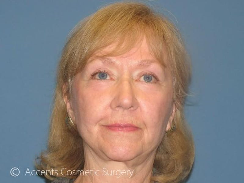 QuickLift Before & After Gallery - Patient 105543 - Image 2