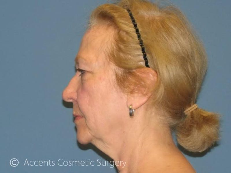 QuickLift Before & After Gallery - Patient 105543 - Image 3
