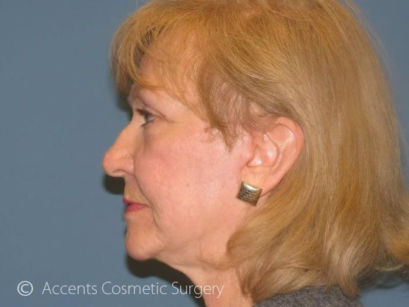 QuickLift Before & After Gallery - Patient 105543 - Image 4