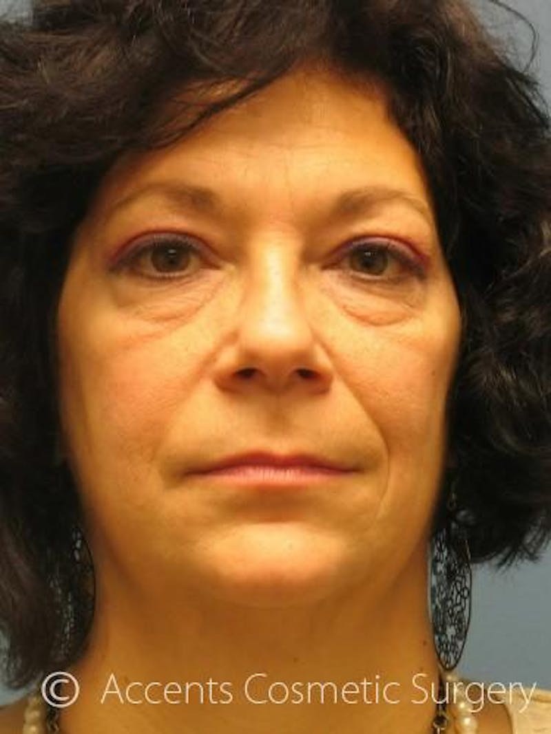 QuickLift Before & After Gallery - Patient 173858 - Image 1