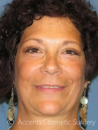 QuickLift Before & After Gallery - Patient 173858 - Image 2