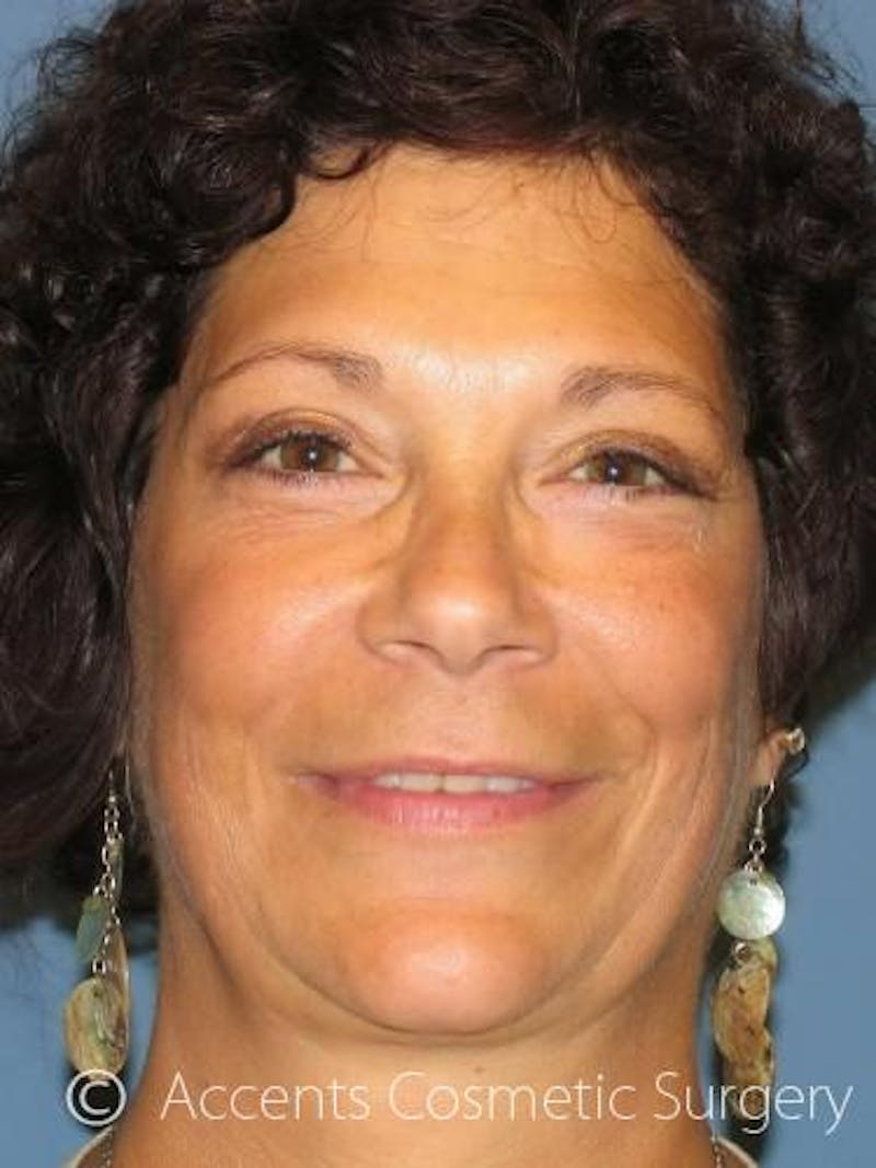 QuickLift Before & After Gallery - Patient 173858 - Image 2