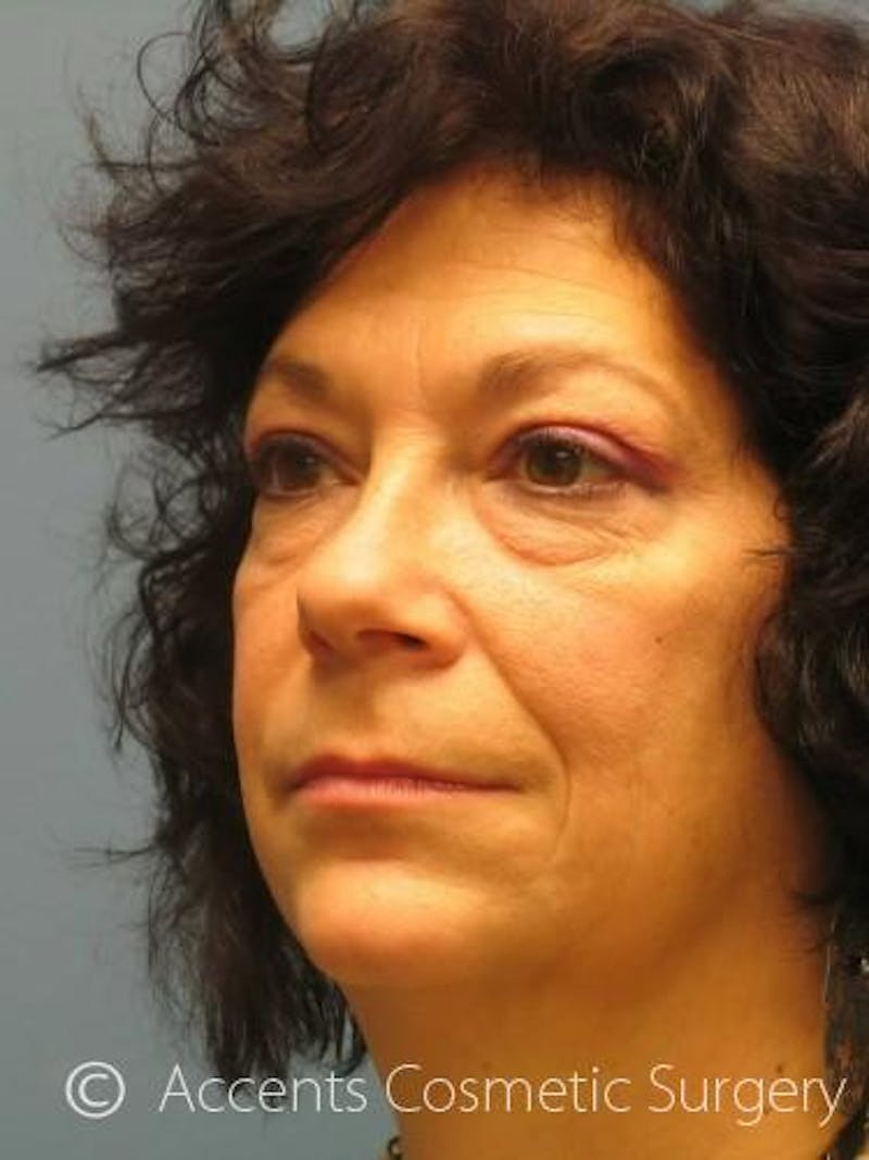 QuickLift Before & After Gallery - Patient 173858 - Image 3