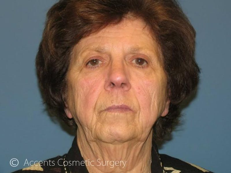 QuickLift Before & After Gallery - Patient 286313 - Image 1
