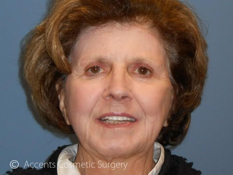 QuickLift Before & After Gallery - Patient 286313 - Image 2