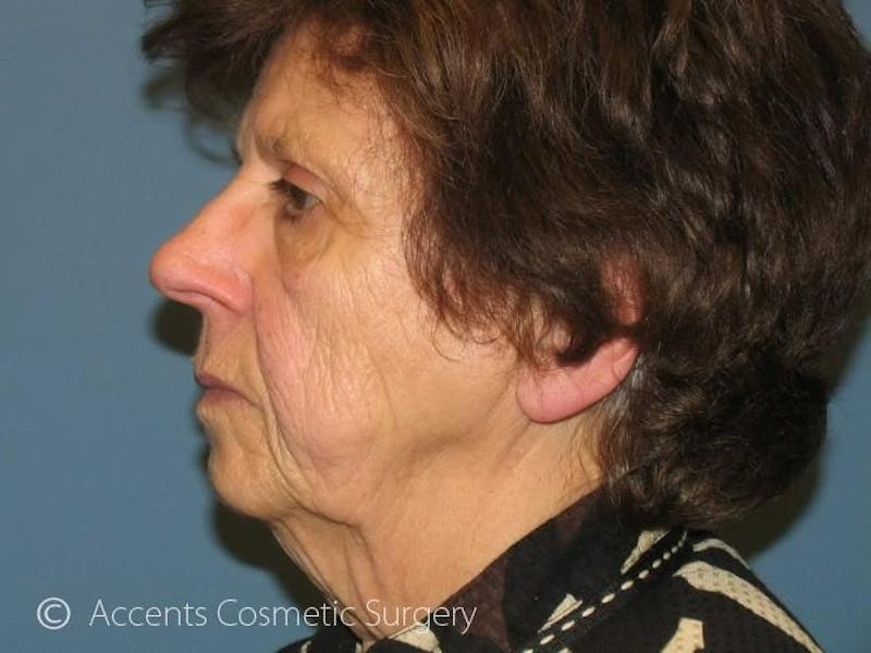 QuickLift Before & After Gallery - Patient 286313 - Image 3