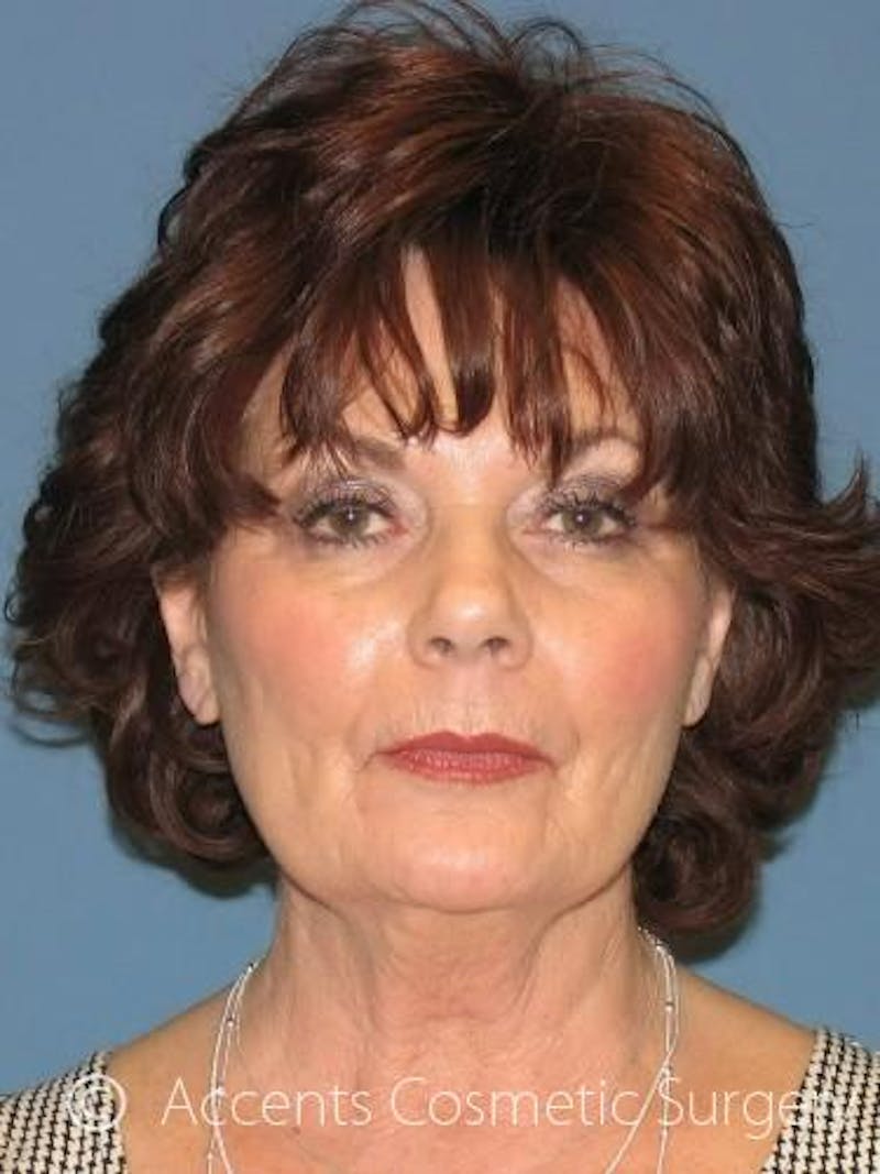 QuickLift Before & After Gallery - Patient 114316 - Image 1
