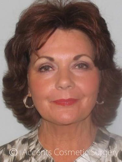 QuickLift Before & After Gallery - Patient 114316 - Image 2