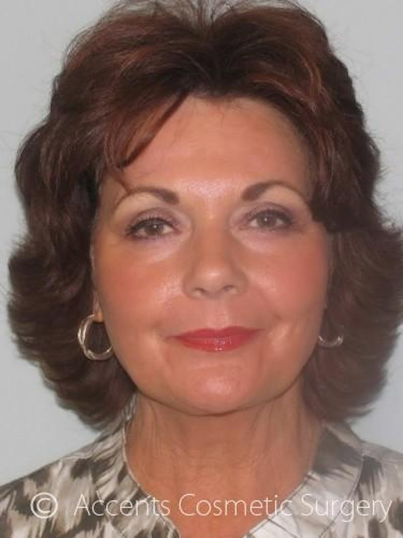 QuickLift Before & After Gallery - Patient 114316 - Image 2