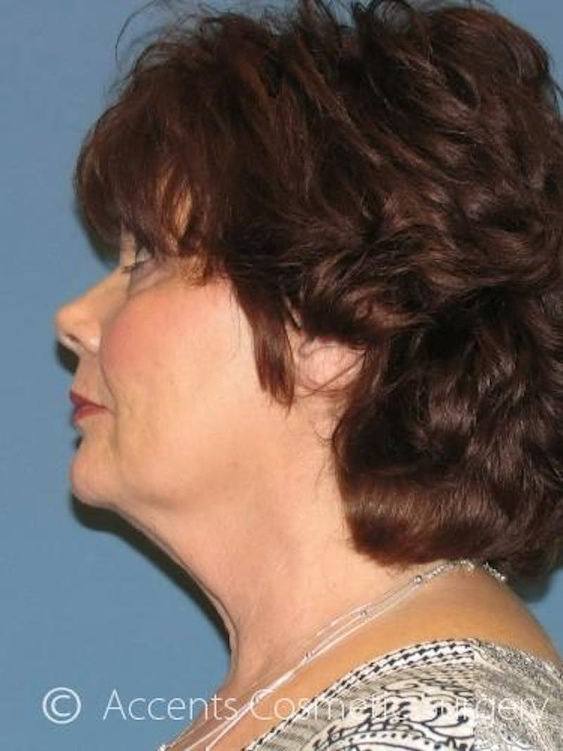 QuickLift Before & After Gallery - Patient 114316 - Image 3