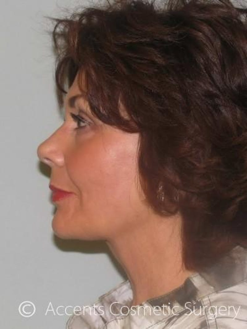 QuickLift Before & After Gallery - Patient 114316 - Image 4