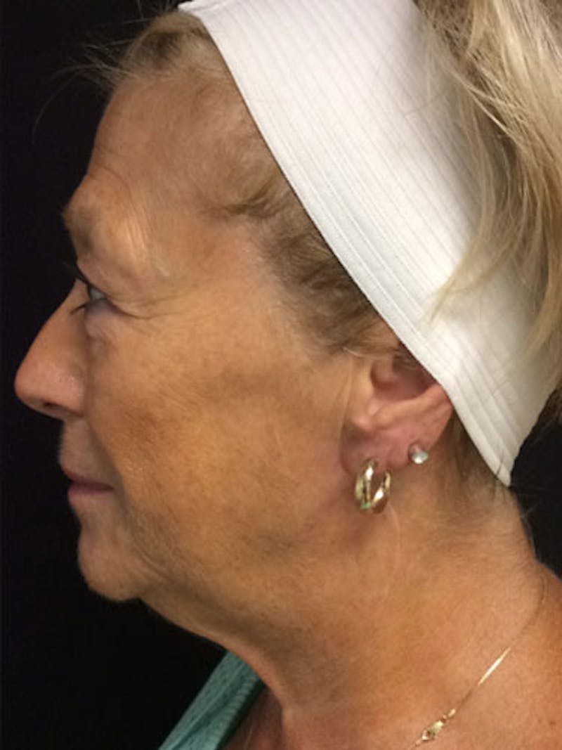 QuickLift Before & After Gallery - Patient 342674 - Image 1