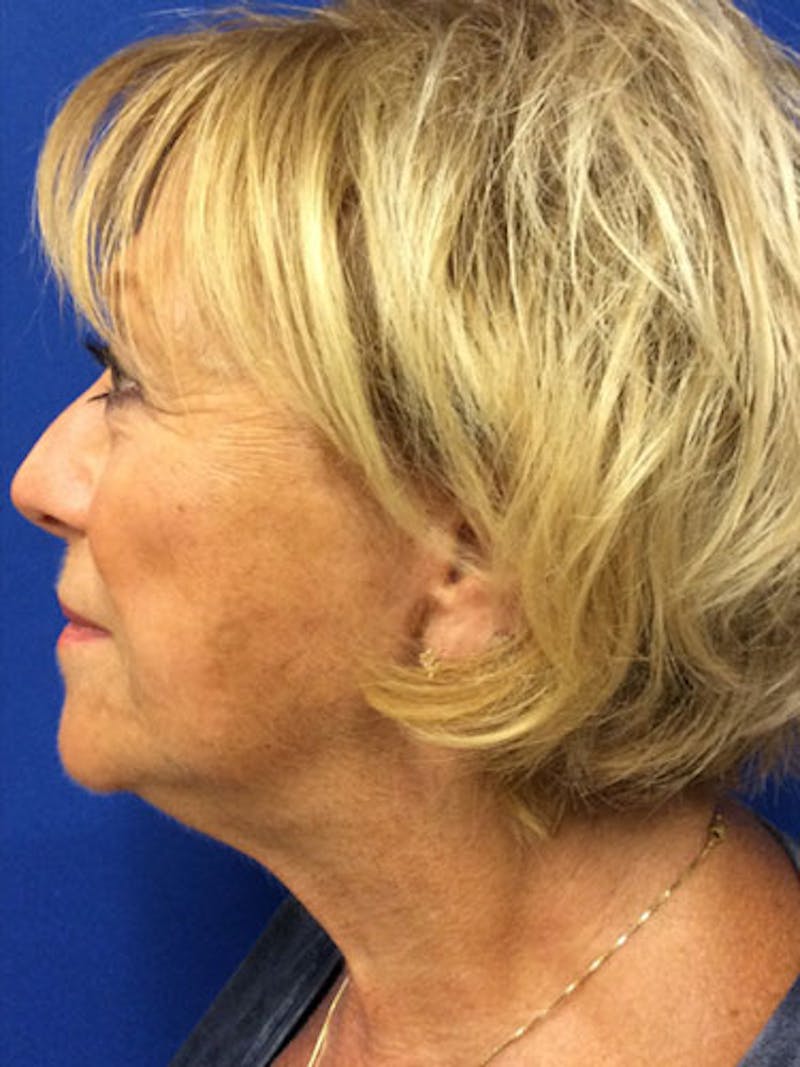 QuickLift Before & After Gallery - Patient 342674 - Image 2