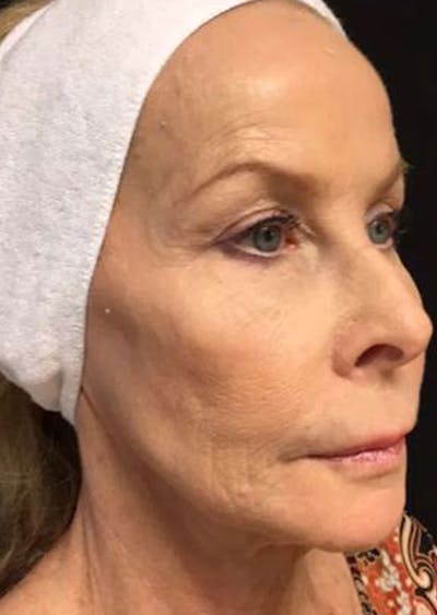 QuickLift Before & After Gallery - Patient 130124 - Image 1