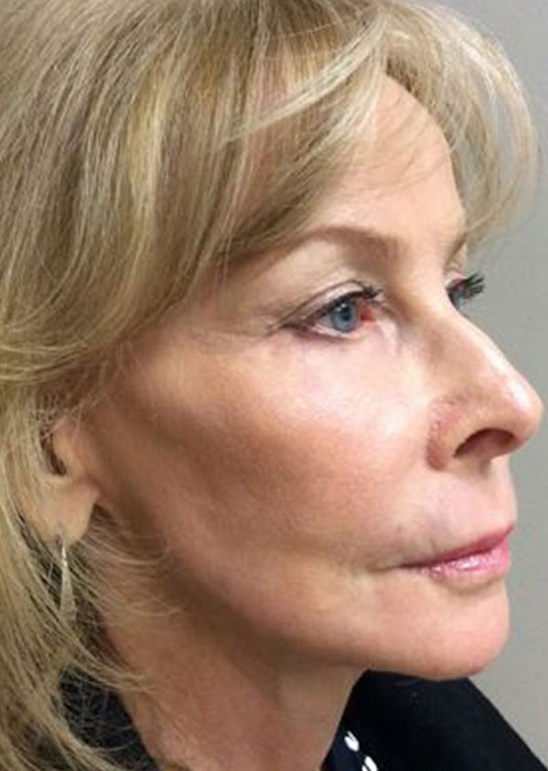 QuickLift Before & After Gallery - Patient 130124 - Image 2