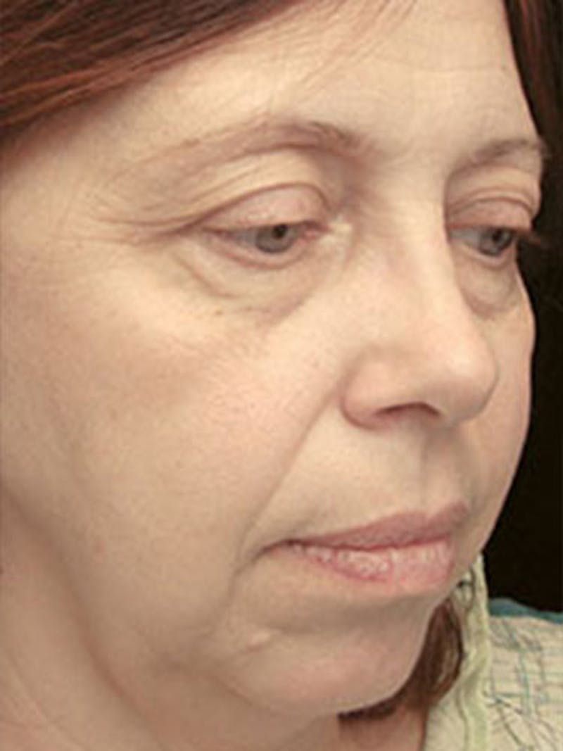 QuickLift Before & After Gallery - Patient 234686 - Image 1