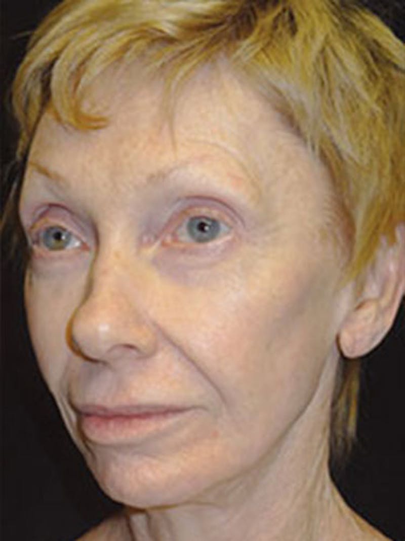 QuickLift Before & After Gallery - Patient 202619 - Image 1