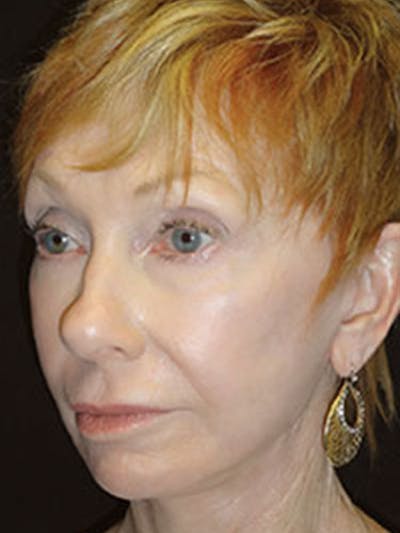 QuickLift Before & After Gallery - Patient 202619 - Image 2