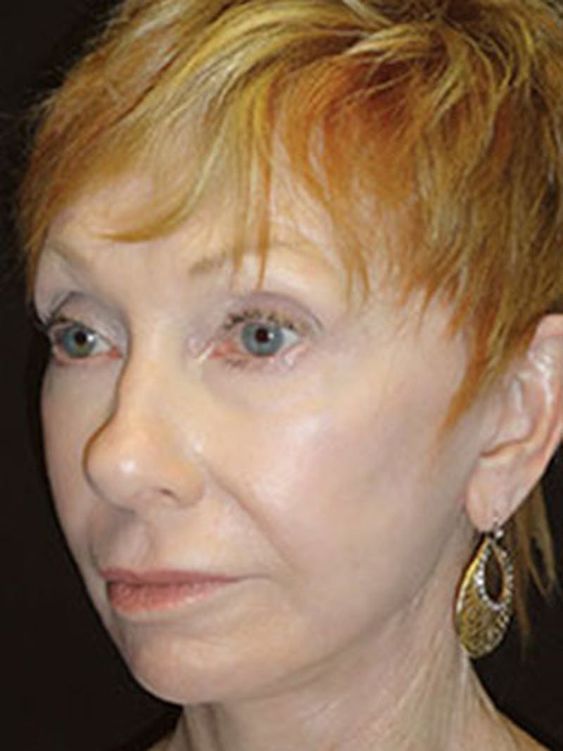 QuickLift Before & After Gallery - Patient 202619 - Image 2