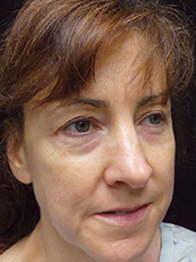 QuickLift Before & After Gallery - Patient 329096 - Image 1