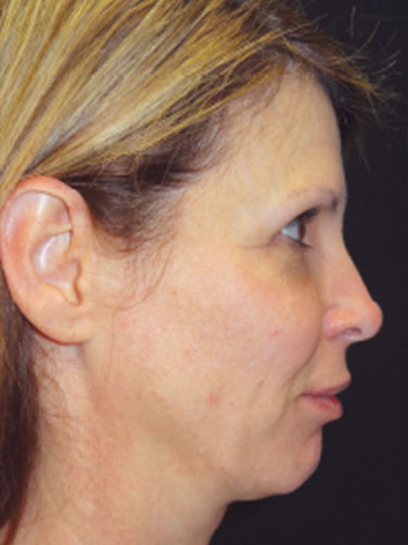 QuickLift Before & After Gallery - Patient 258730 - Image 1