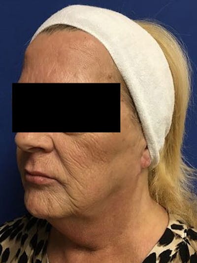 QuickLift Before & After Gallery - Patient 257601 - Image 1