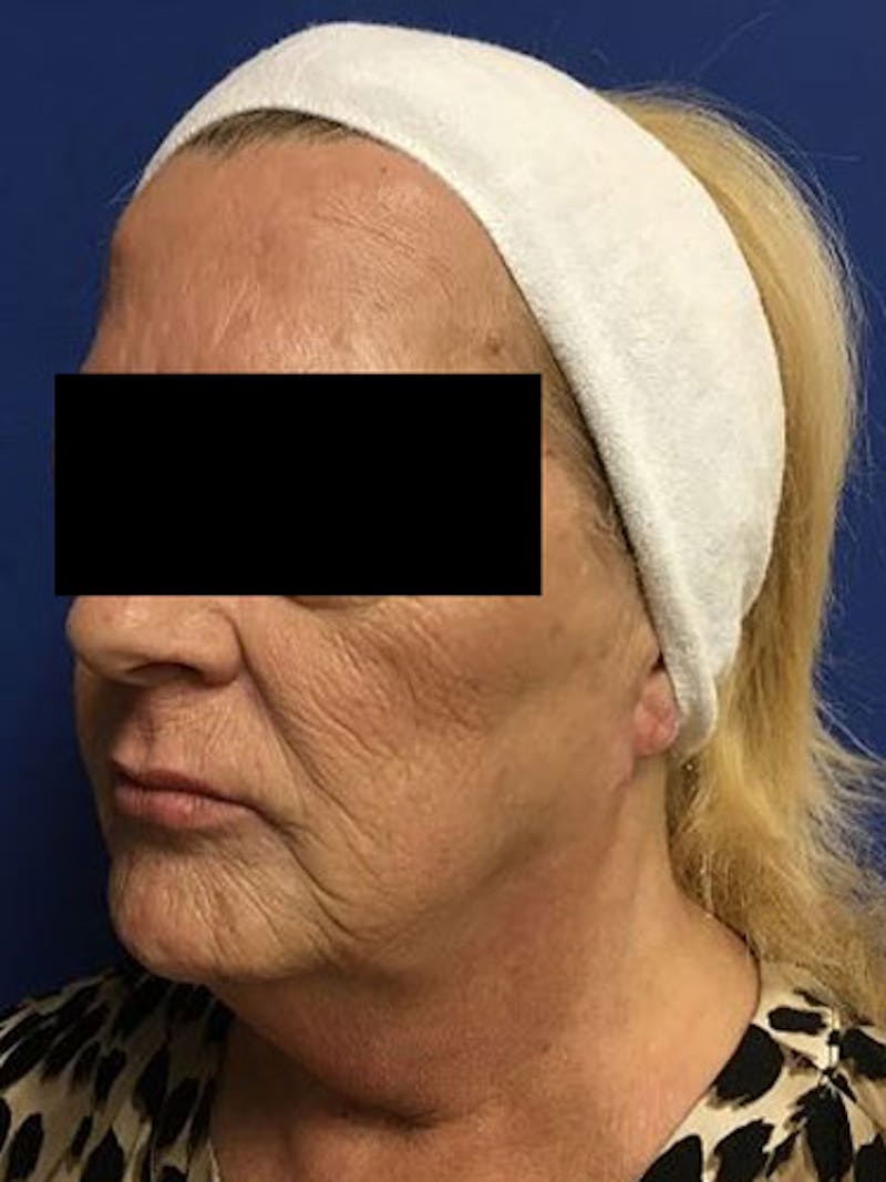 QuickLift Before & After Gallery - Patient 257601 - Image 1