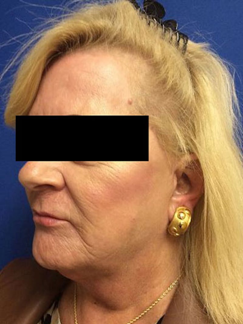 QuickLift Before & After Gallery - Patient 257601 - Image 2