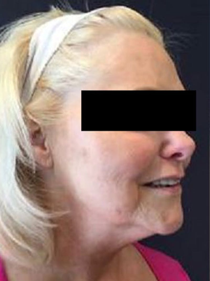 QuickLift Before & After Gallery - Patient 271746 - Image 1