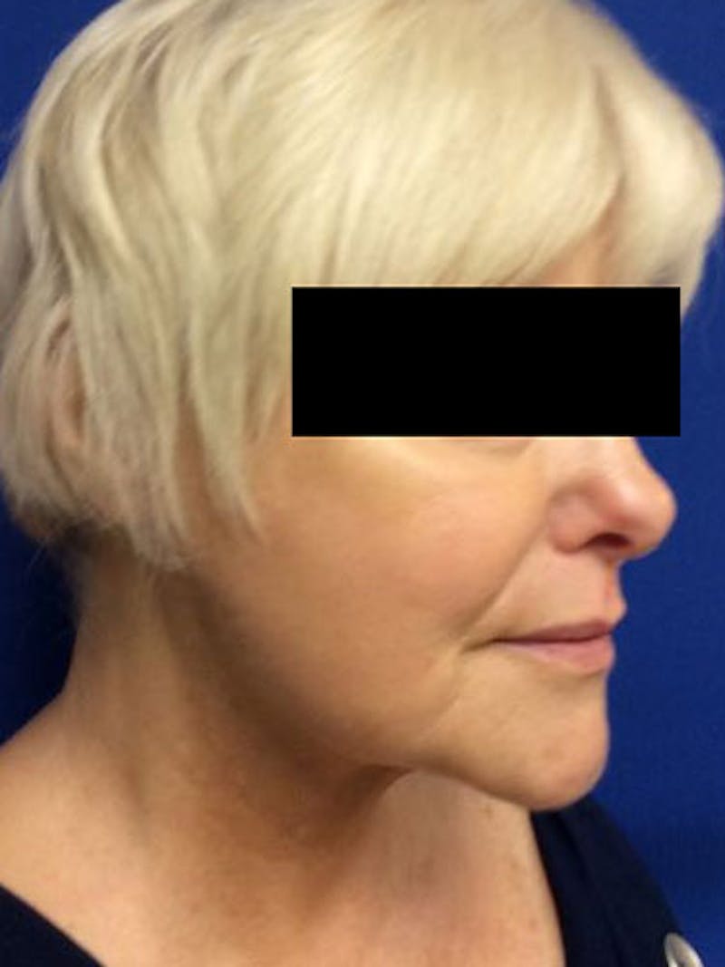 QuickLift Before & After Gallery - Patient 271746 - Image 2