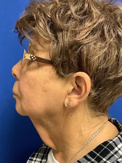 QuickLift Before & After Gallery - Patient 107030 - Image 1