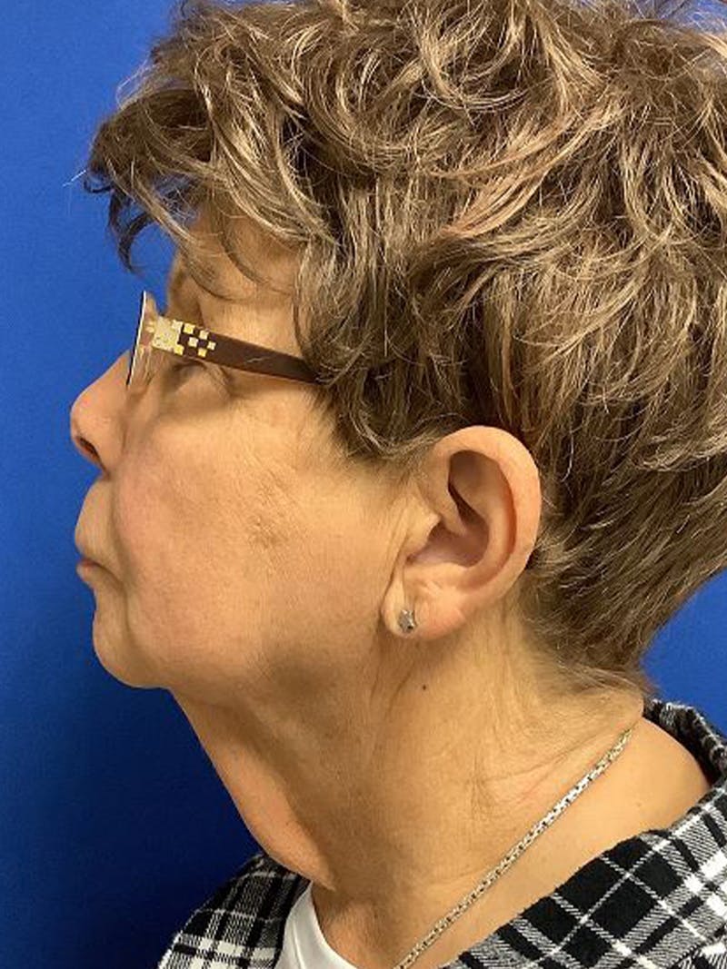 QuickLift Before & After Gallery - Patient 107030 - Image 1