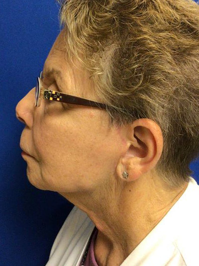 QuickLift Before & After Gallery - Patient 107030 - Image 2