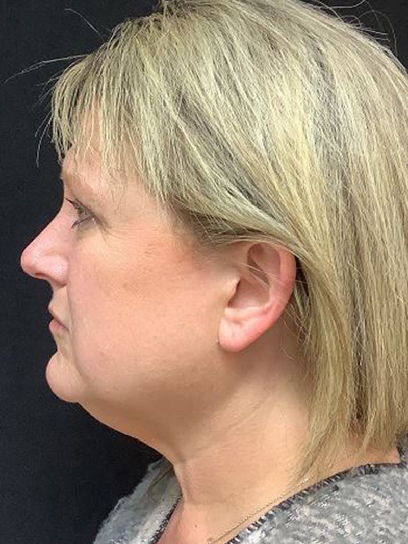 QuickLift Before & After Gallery - Patient 161419 - Image 1