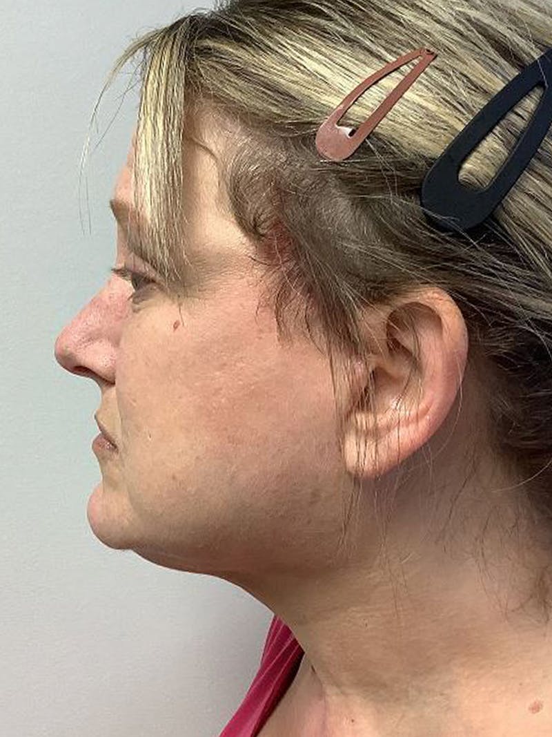 QuickLift Before & After Gallery - Patient 161419 - Image 2