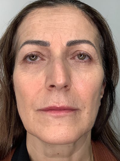 Thread Lift Facelift Before & After Gallery - Patient 408900 - Image 1