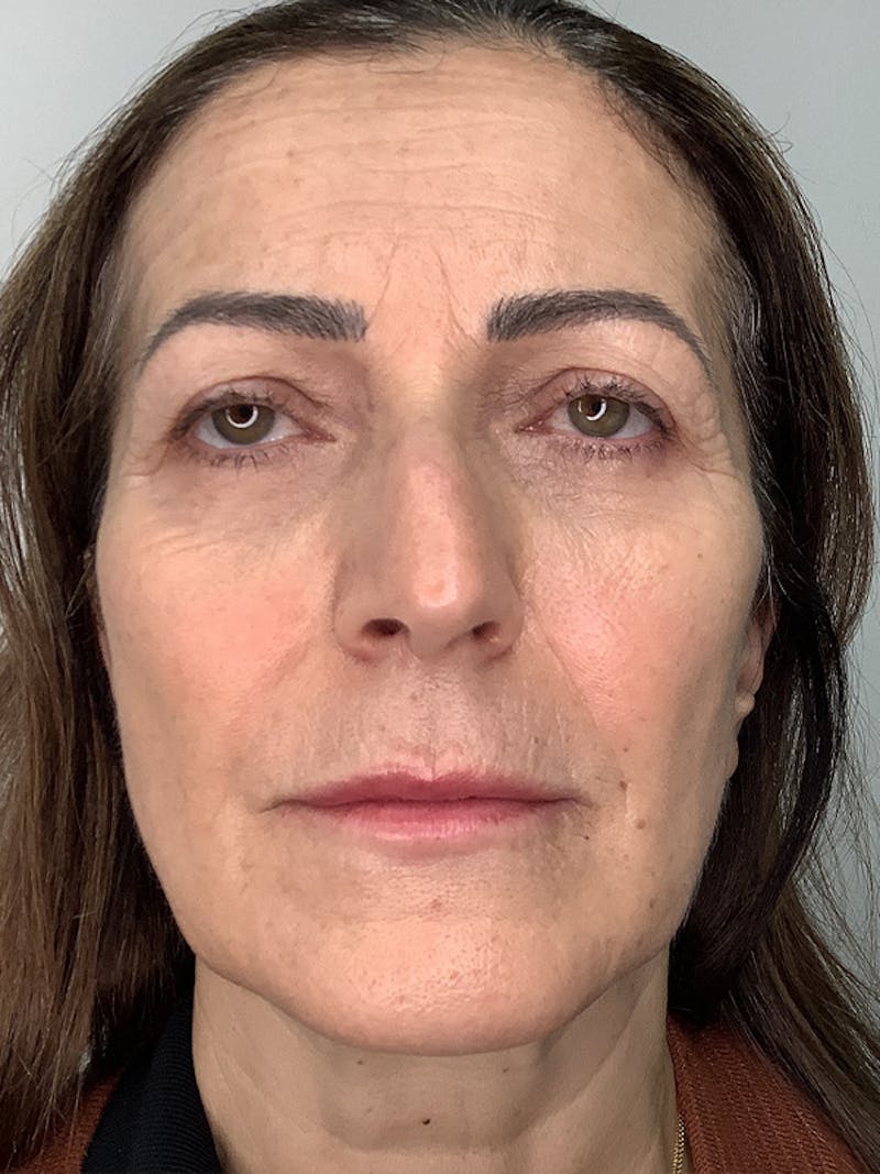 Fat Transfer Before & After Gallery - Patient 536682 - Image 1